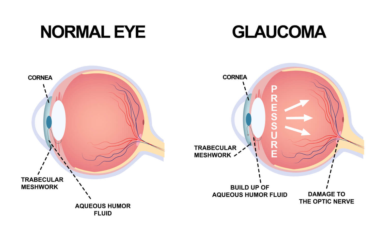 Glaucoma Treatment in Amanora, Amanora Park Town, Hadapsar